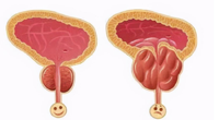 前列腺痛怎么办