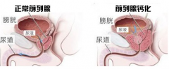 开封治疗前列腺钙化哪家医院好？