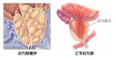 开封治疗前列腺囊肿多少钱？